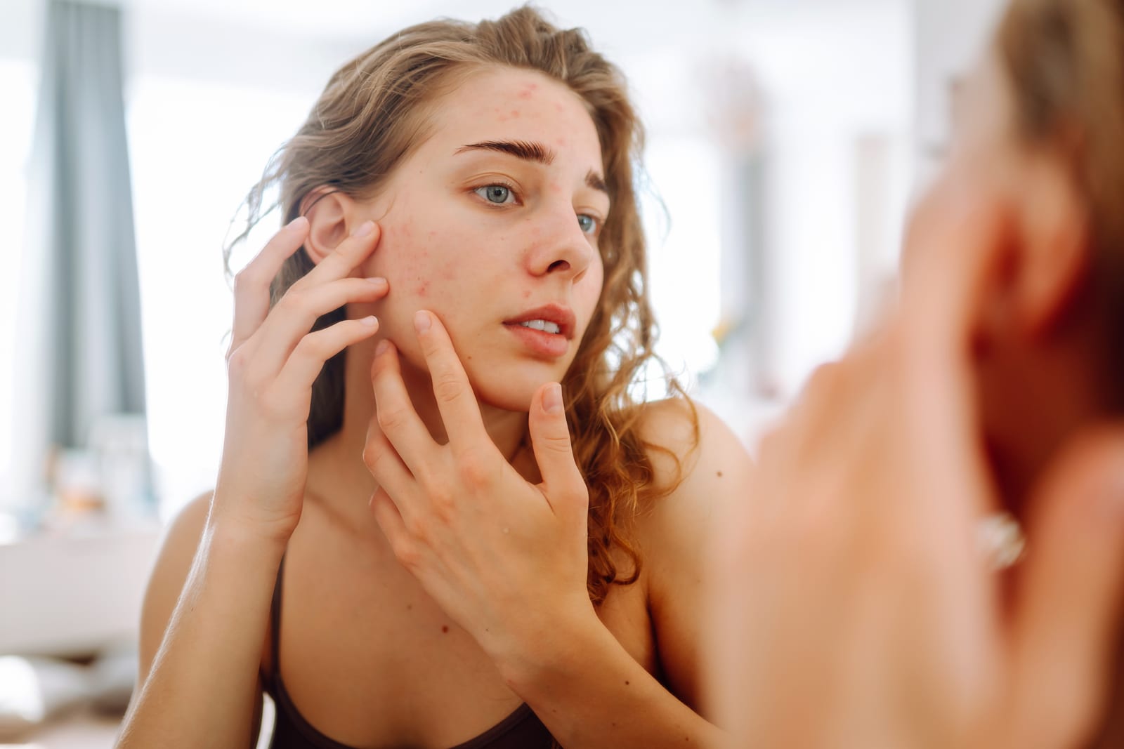 Acne & Scar Revision treatment at Sun Aesthetic Clinic, Bellevue WA