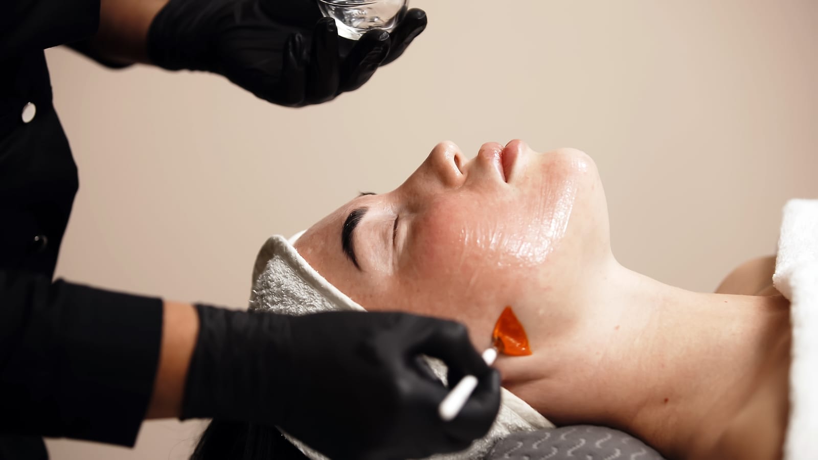 Chemical Peels treatment at Sun Aesthetic Clinic, Bellevue WA