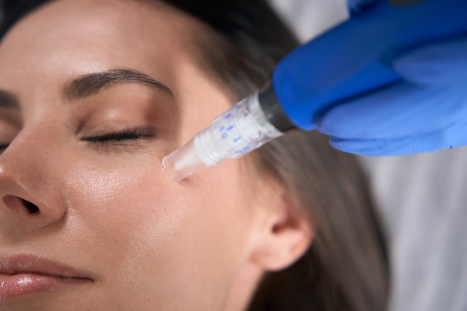 Microneedling — Sun Aesthetic Clinic, Bellevue WA