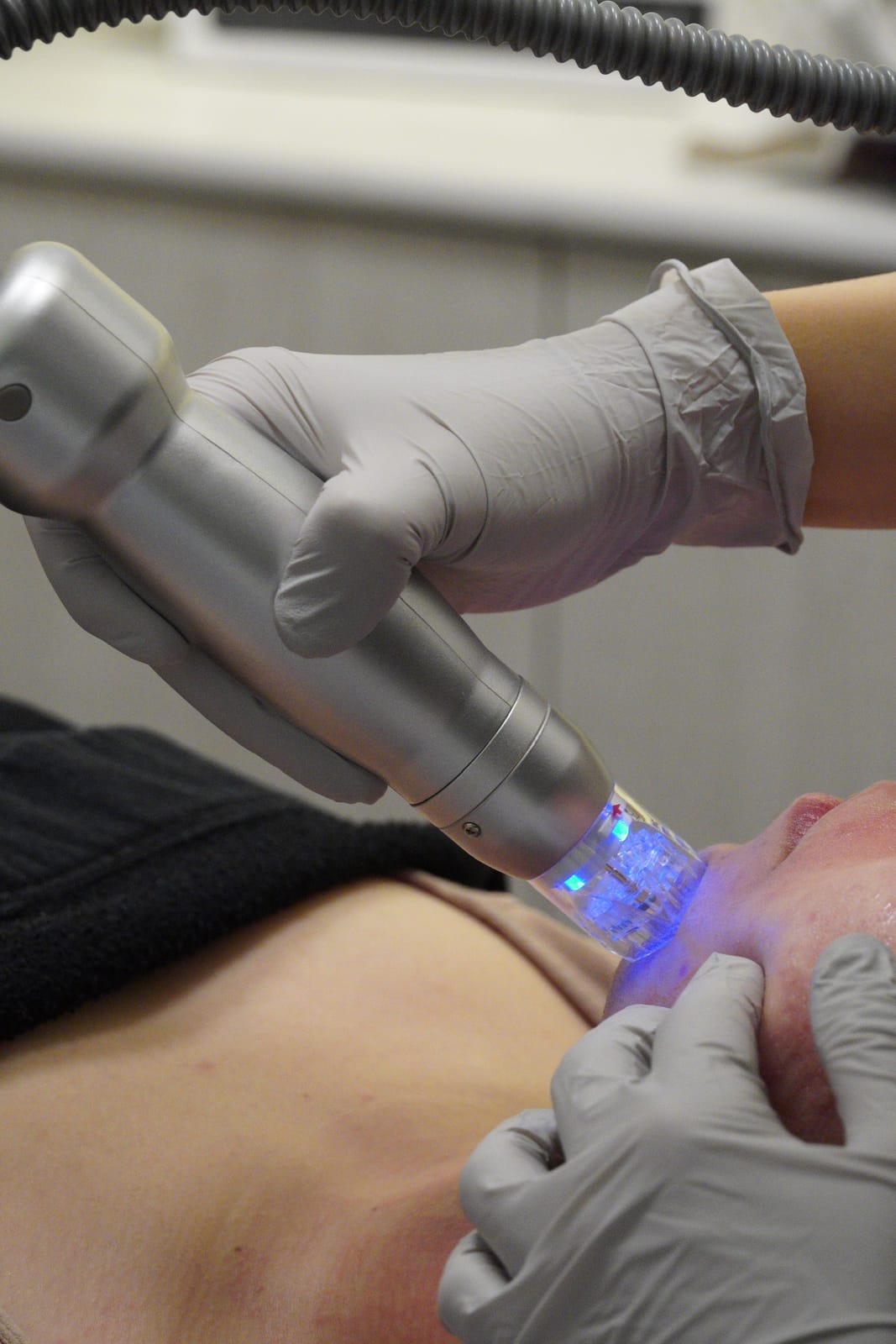 Microneedling treatment at Sun Aesthetic Clinic, Bellevue WA