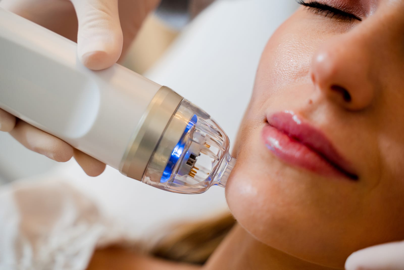 Scarlet RF — Sun Aesthetic Clinic, Bellevue WA