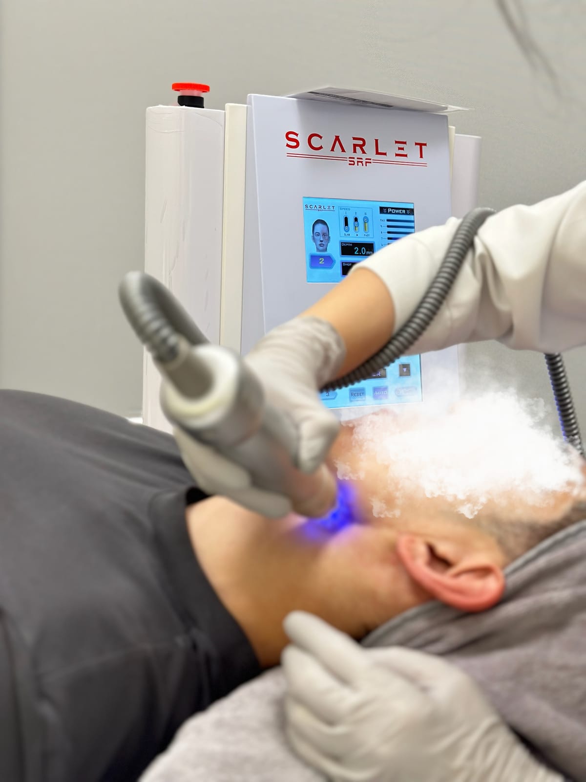 Scarlet RF treatment at Sun Aesthetic Clinic, Bellevue WA