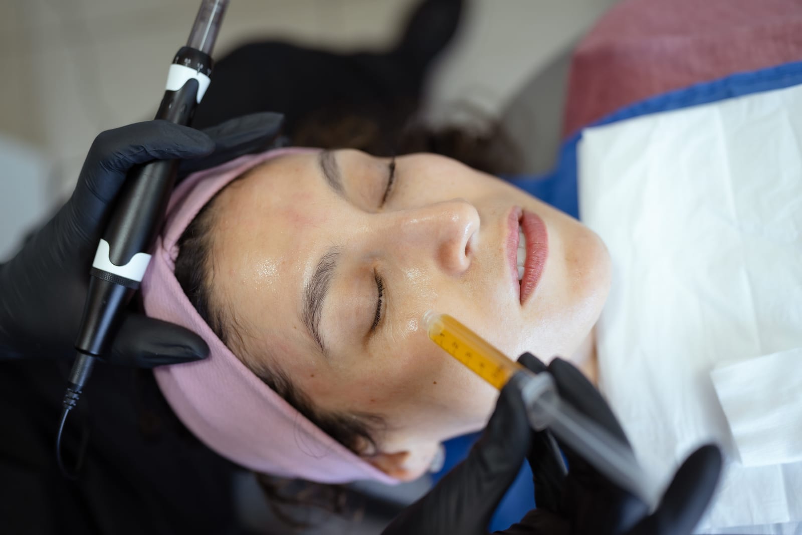 Vampire Facial — Sun Aesthetic Clinic, Bellevue WA