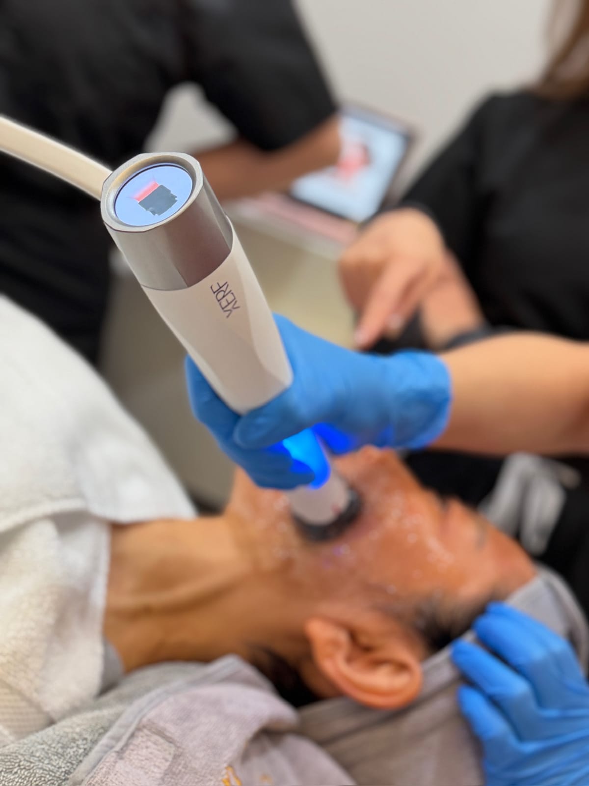XERF treatment at Sun Aesthetic Clinic, Bellevue WA